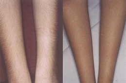 laser hair removal in abu dhabi before & after