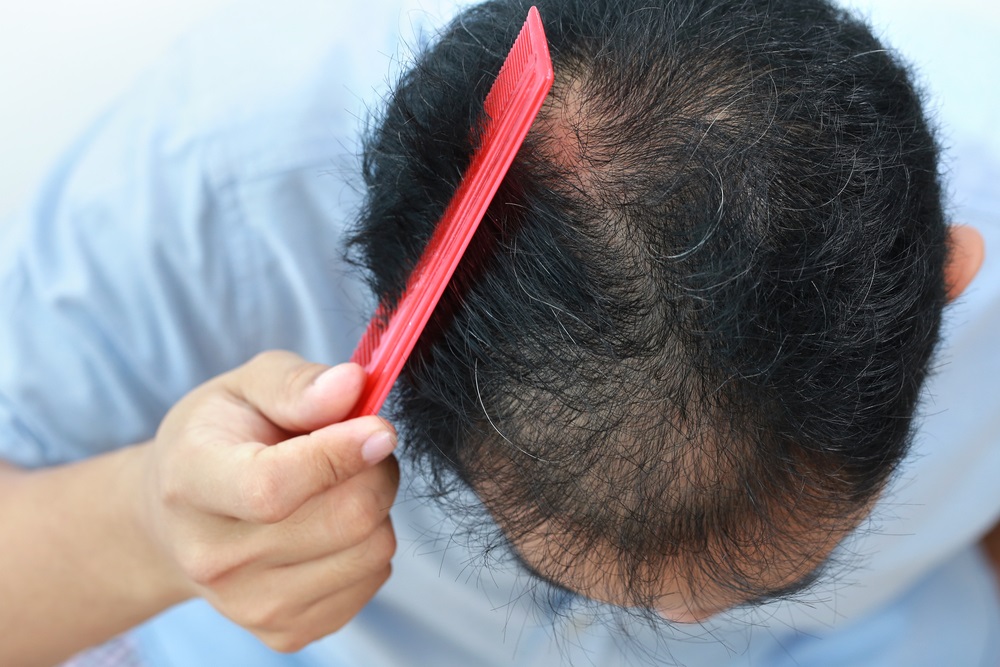 Hair Transplant in Abu Dhabi 9